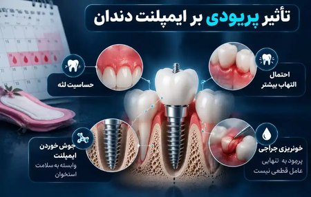 تأثیر پریودی بر جراحی ایمپلنت دندان چیست؟ تأثیر پریودی بر جراحی ایمپلنت دندان چیست؟