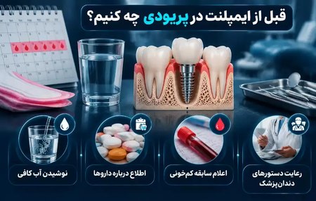قبل از ایمپلنت در پریودی چه نکاتی را رعایت کنیم؟ قبل از ایمپلنت در پریودی چه نکاتی را رعایت کنیم؟