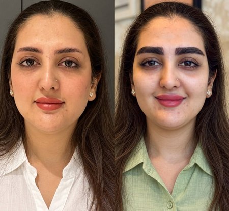 تصویر نمونه قبل و بعد کاشت ابرو تصویر نمونه قبل و بعد کاشت ابرو