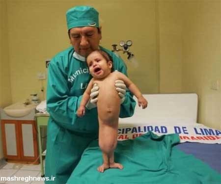 دختری با سندرم پری دریایی!+عکس دختری با سندرم پری دریایی!+عکس