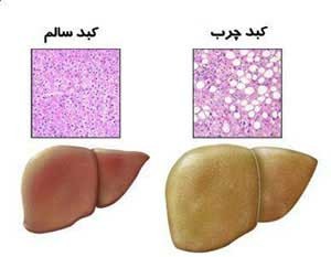 بیماری كبد چرب غیرالكلی خطر مرگ را افزایش نمی دهد