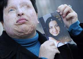 اسیدپاشی,اسید پاشیدن روی صورت,تصاویر اسیدپاشی,قربانی اسید پاشی,اخبار حوادث91,حوادث امروز  