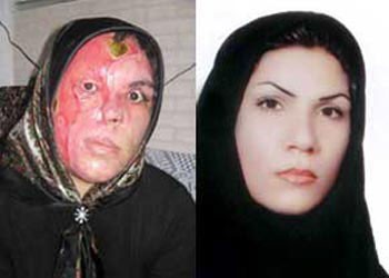 اسیدپاشی,اسید پاشیدن روی صورت,تصاویر اسیدپاشی,قربانی اسید پاشی,اخبار حوادث91,حوادث امروز  