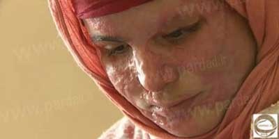 اسیدپاشی , عکس اسیدپاشی