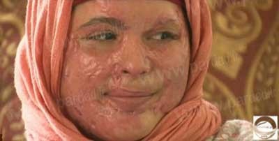 اسیدپاشی , عکس اسیدپاشی