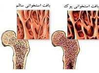 چاقی شکمی,خطر ابتلا به پوکی استخوان
