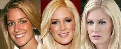 هایدی مونتاگ,بازیگران  سینما و تلویزیون,بازیگرانی که عمل زیبایی انجام داده اند