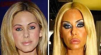 شائونا سند,بازیگران  سینما و تلویزیون,بازیگرانی که عمل زیبایی انجام داده اند