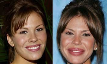 «نیکی کوکس»,بازیگران  سینما و تلویزیون,بازیگرانی که عمل زیبایی انجام داده اند