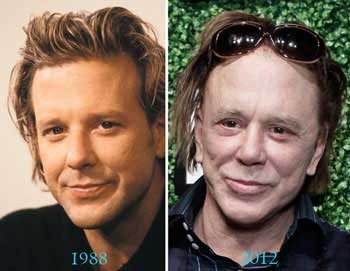 میکی رورکه,بازیگران  سینما و تلویزیون,بازیگرانی که عمل زیبایی انجام داده اند