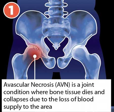 اخبار,اخبار علمی ,ترمیم مفصل استخوان ران