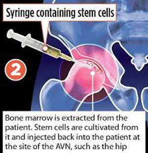 اخبار,اخبار علمی ,ترمیم مفصل استخوان ران