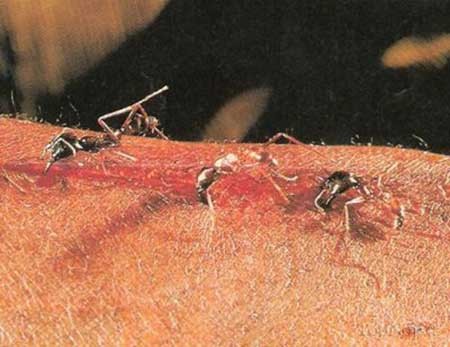 اخبار,اخبار علمی ,بخیه زدن زخم با مورچه