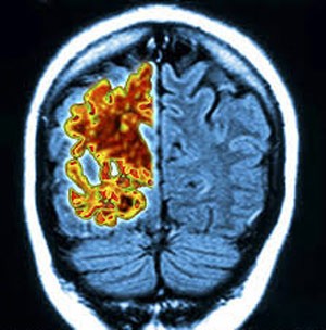 اخبار , اخبار علمی,تشخیص زودهنگام آلزایمر,تشخیص زودهنگام تومورهای مغزی