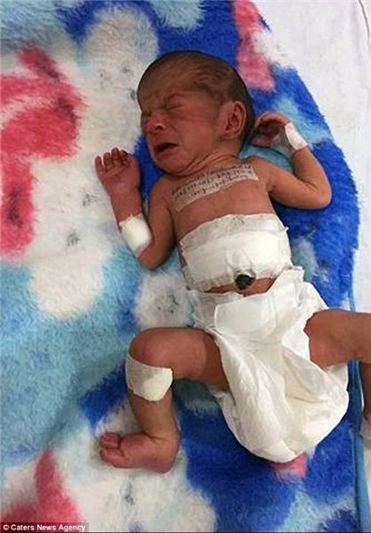 اخبار,اخبار گوناگون,جراحی موفقیت‌آمیز نوزاد دو سر در هندوستان