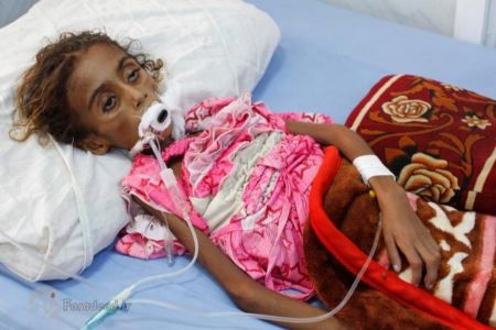     مرگ دختر یمنی بر اثر سوءتغذیه
