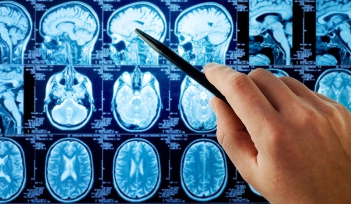 اخبار پزشکی ,خبرهای پزشکی ,سرطان مغز اخبار پزشکی ,خبرهای پزشکی,سرطان مغز