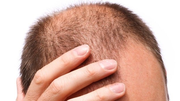 اخبار علمی,خبرهای علمی , ریزش مو اخبار علمی ,خبرهای علمی, ریزش مو
