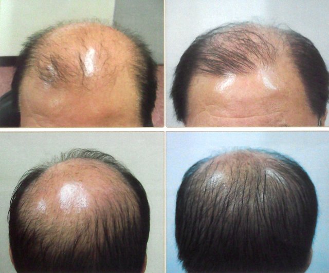 اخبار علمی,خبرهای علمی , ریزش مو اخبار علمی ,خبرهای علمی, ریزش مو