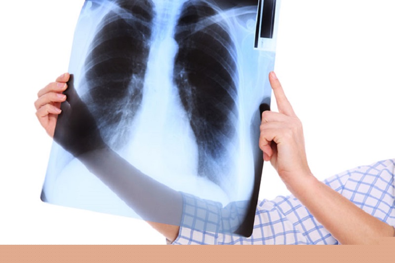 اخبار پزشکی ,خبرهای پزشکی ,ریه اخبار پزشکی ,خبرهای پزشکی,ریه
