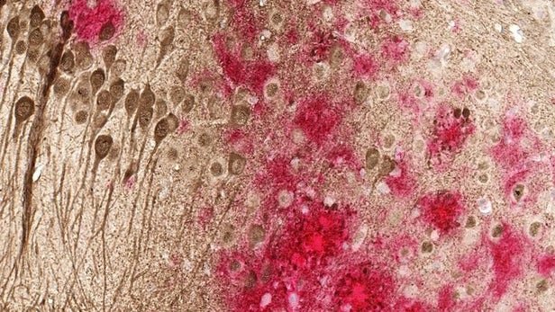 اخبار پزشکی ,خبرهای پزشکی , آلزایمر اخبار پزشکی ,خبرهای پزشکی, آلزایمر