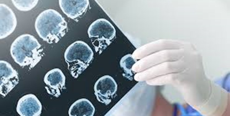 اخبار پزشکی ,خبرهای پزشکی ,زوال عقل اخبار پزشکی ,خبرهای پزشکی,زوال عقل
