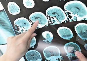 اخبار پزشکی ,خبرهای پزشکی , MS اخبار پزشکی ,خبرهای پزشکی, MS