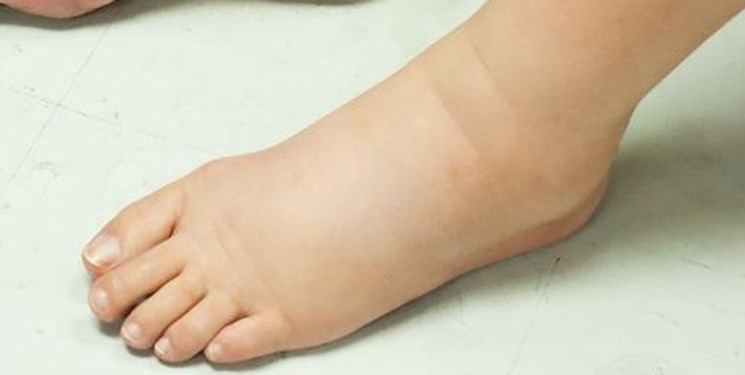 اخبار پزشکی ,خبرهای پزشکی ,تورم پاها اخبار پزشکی ,خبرهای پزشکی,تورم پاها