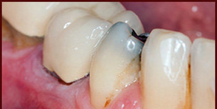اخبار پزشکی ,خبرهای پزشکی ,پوسیدگی دندان اخبار پزشکی ,خبرهای پزشکی,پوسیدگی دندان
