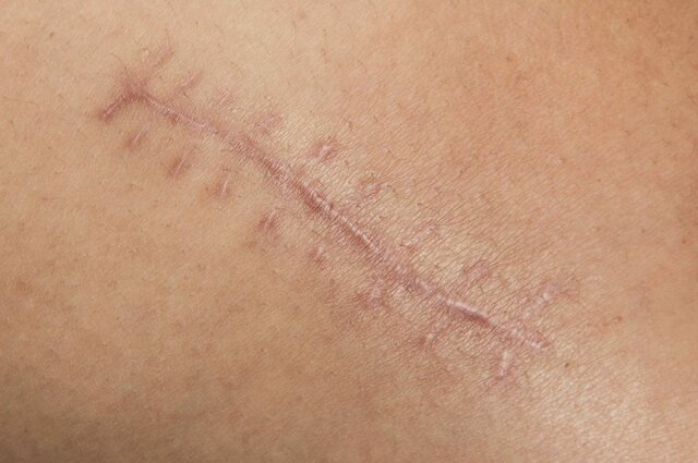 اخبار پزشکی ,خبرهای پزشکی ,زخم اخبار پزشکی ,خبرهای پزشکی,زخم