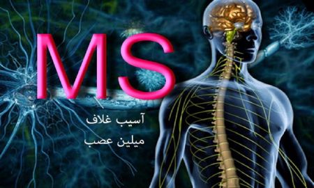 اخبار پزشکی ,خبرهای پزشکی , بیماری ام اس اخبار پزشکی ,خبرهای پزشکی, بیماری ام اس