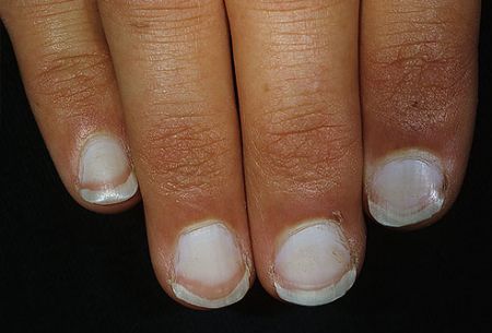 اخبار پزشکی ,خبرهای پزشکی ,ناخنها اخبار پزشکی ,خبرهای پزشکی,ناخنها