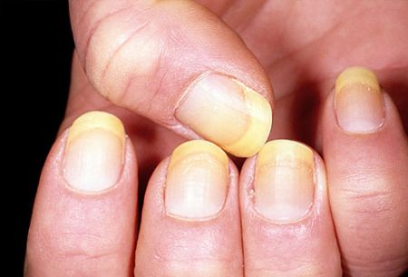 اخبار پزشکی ,خبرهای پزشکی ,ناخنها اخبار پزشکی ,خبرهای پزشکی,ناخنها