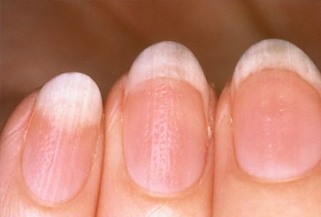 اخبار پزشکی ,خبرهای پزشکی ,ناخنها اخبار پزشکی ,خبرهای پزشکی,ناخنها