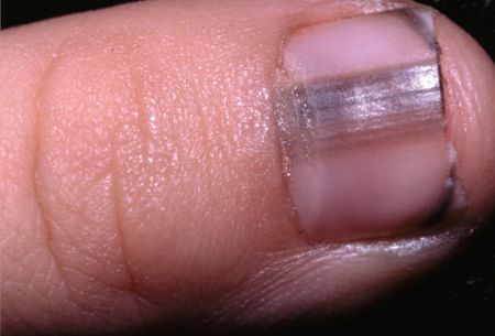 اخبار پزشکی ,خبرهای پزشکی ,ناخنها اخبار پزشکی ,خبرهای پزشکی,ناخنها