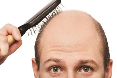 اخبار پزشکی ,خبرهای پزشکی , ریزش ارثی مو اخبار پزشکی ,خبرهای پزشکی, ریزش ارثی مو