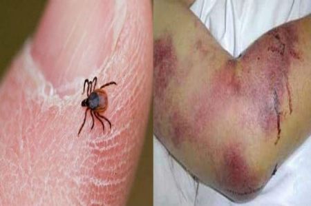 اخبار پزشکی ,خبرهای پزشکی ,تب کریمه کنگو اخبار پزشکی ,خبرهای پزشکی,تب کریمه کنگو