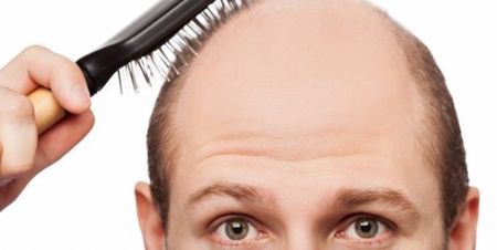 اخبار پزشکی ,خبرهای پزشکی ,ریزش مو و طاسی اخبار پزشکی ,خبرهای پزشکی,ریزش مو و طاسی