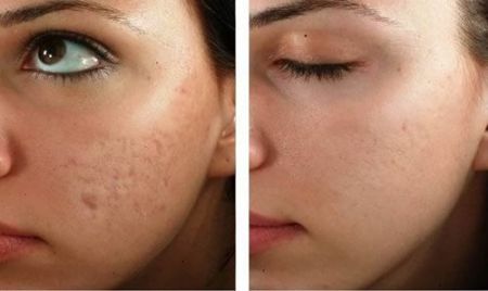  اخبار پزشکی ,خبرهای پزشکی, آکنه