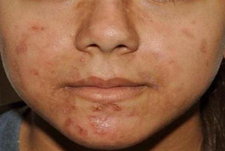 اخبار,اخبار پزشکی,بیماران مبتلا به آکنه اخبار,اخبار پزشکی,بیماران مبتلا به آکنه