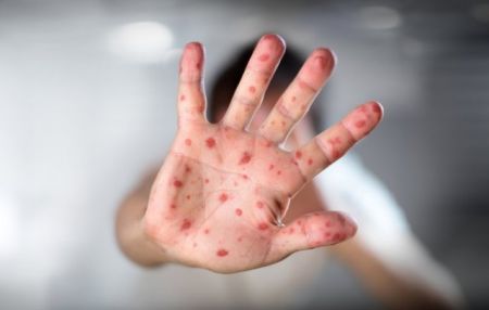 اخبار,اخبار پزشکی,سرخک اخبار,اخبار پزشکی,سرخک