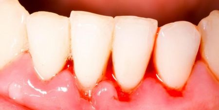 اخبار پزشکی ,خبرهای پزشکی , بیماریهای لثه اخبار پزشکی ,خبرهای پزشکی, بیماریهای لثه