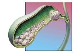  اخبار پزشکی ,خبرهای پزشکی, سنگ کیسه صفرا