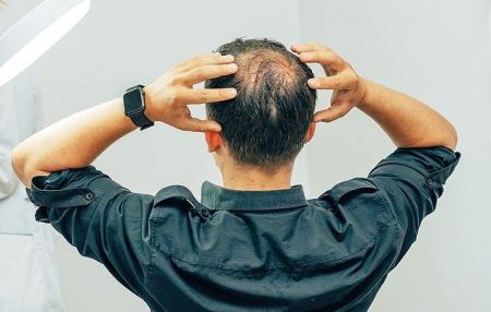 اخبار پزشکی ,خبرهای پزشکی ,طاسی اخبار پزشکی ,خبرهای پزشکی,طاسی