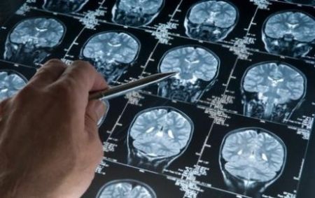 اخبار پزشکی ,خبرهای پزشکی ,آلزایمر اخبار پزشکی ,خبرهای پزشکی,آلزایمر