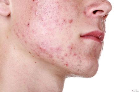 اخبار پزشکی ,خبرهای پزشکی ,آکنه اخبار پزشکی ,خبرهای پزشکی,آکنه