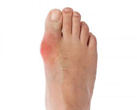 اخبار پزشکی ,خبرهای پزشکی ,نقرس اخبار پزشکی ,خبرهای پزشکی,نقرس