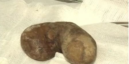 اخبار پزشکی ,خبرهای پزشکی ,سنگ کلیه اخبار پزشکی ,خبرهای پزشکی,سنگ کلیه
