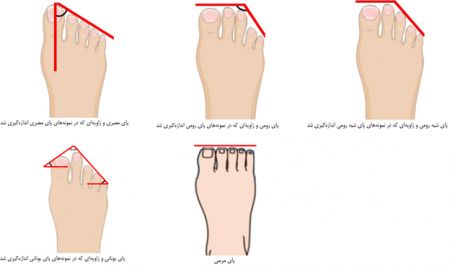 اخبار پزشکی ,خبرهای پزشکی ,پای ایرانیان اخبار پزشکی ,خبرهای پزشکی,پای ایرانیان