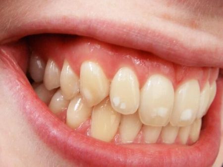اخبار پزشکی ,خبرهای پزشکی ,فلوراید اخبار پزشکی ,خبرهای پزشکی,فلوراید